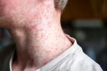 Measles rash. (Photo by Natalya Maisheva/iStock / Getty Images Plus)